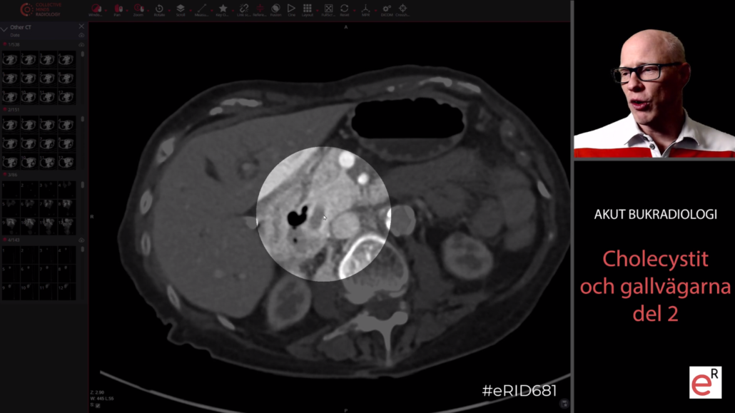 akut bukradiologi erad exempel