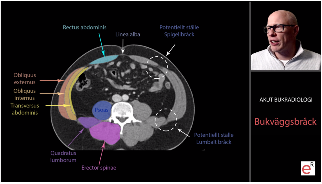 akut bukradiologi erad exempel