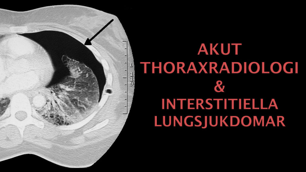 akut thoraxradiologi, thoraxradiologi kurs, interstitiella lungsjukdomar radiologi, erad thoraxradiologi, thoraxradiologi utbildning st läkare